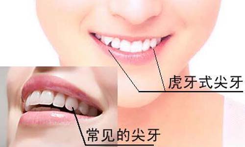 長有虎牙的女性感情事業運勢好不好